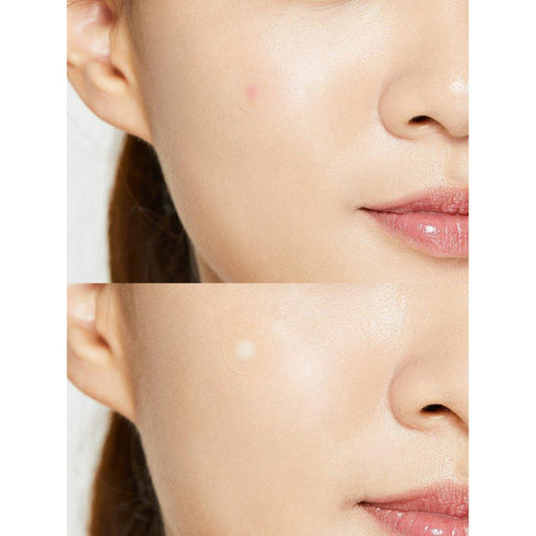 Acne Pimple Master Patch 24patches