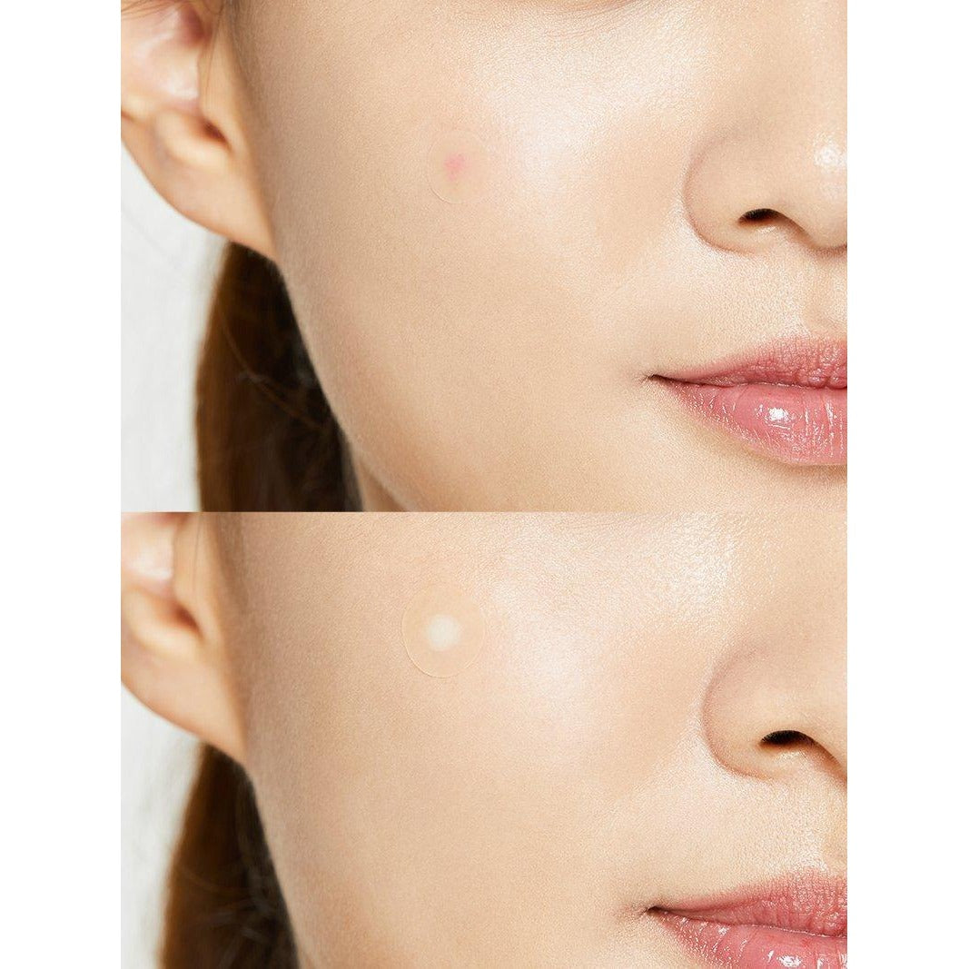 Acne Pimple Master Patch 24patches
