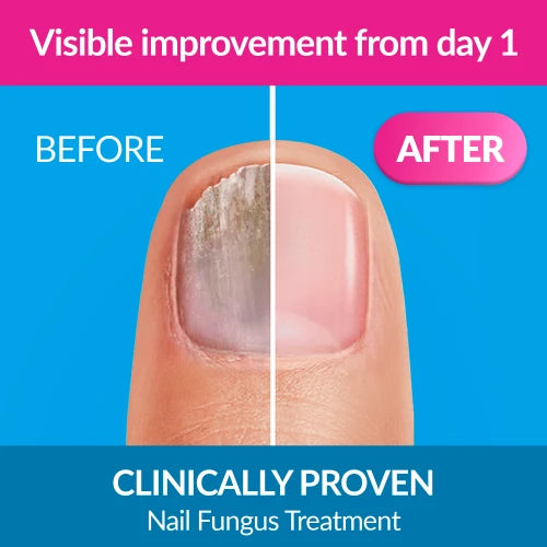 Excilor Ultra Fungal Nail Treatment 30ml-Actor Pharmaceuticals-Matakana Pharmacy