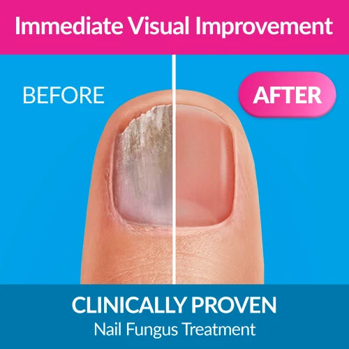 Excilor Nail Fungus Forte Ultra Colour Nude 30ml Bottle-Actor Pharmaceuticals-Matakana Pharmacy