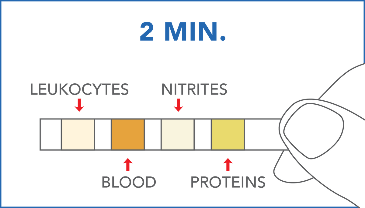 Image of PRIMA Urinary Tract Infections Home Test Kit results